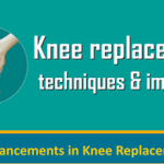 10-minute guide to Knee Replacement