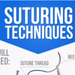 Suturing Techniques – Guide (Infographic)